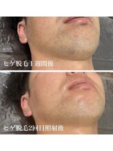 ホッコリ 段原店(HOKKORI)/人気No.1！ヒゲ脱毛♪