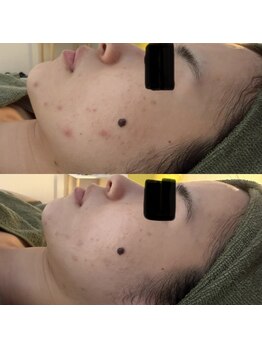 シーアイエステティック 船橋駅前店(c.iエステティック)/お顔のハーブピーリング♪