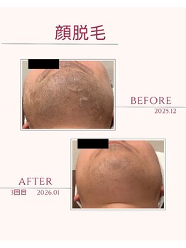 シール(Syl)/メンズ顔脱毛