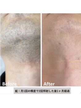 グロワール(gloire)/ヒゲ脱毛