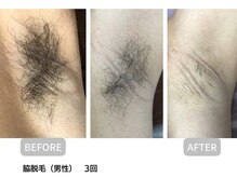 サロン ルーシュ(salon ruche)/脱毛(両脇)