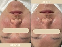 エクラ(eclat)/施術回数：1回