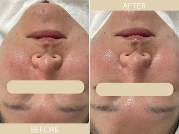 エクラ(eclat)/施術回数:1回