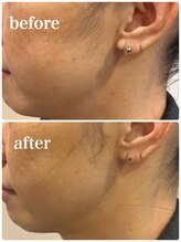 ルル 北仙台/お客様Before/After　たるみ