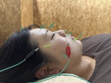 ユーフォリア(Euphoria)/美容鍼灸