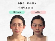 ウェリナ 一宮院/【小顔矯正before→after】