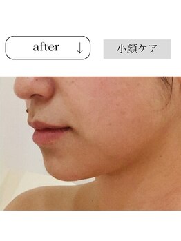 アイチューズ(ICHOOSE)/フェイスラインがスッキリ