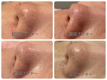 ソワン ド ブランシュ ライフ八戸ノ里店(Soin de Blanche)/毛穴洗浄全顔(お鼻周りの画像)