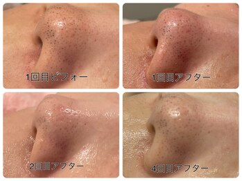 ソワン ド ブランシュ ライフ八戸ノ里店(Soin de Blanche)/毛穴洗浄全顔(お鼻周りの画像)