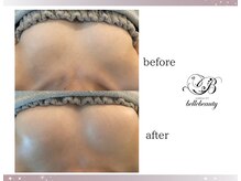 ベルビューティー(belle beauty)/バストアップ◇症例◇