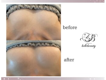 ベルビューティー(belle beauty)/バストアップ◇症例◇