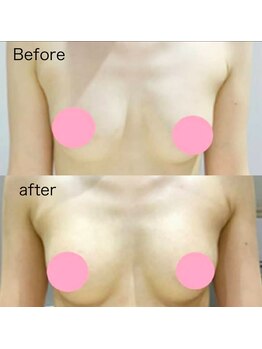 ベッピン(Beppin)/バストアップ症例写真