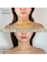 術後の女神 大阪心斎橋店/術後ケアインディバ・インディバ