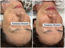 エミマス ボーテ(Emimas Beaute’)/６０代　幹細胞５回目