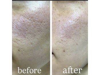 アヌヘア(Anuhea)/ニキビ悩み改善にプラズマニア