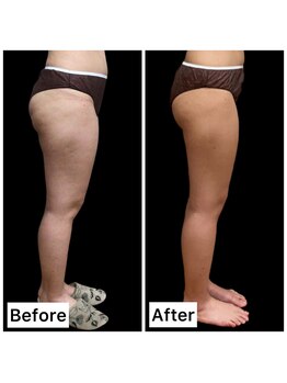 クールヴィラ(Cool Villa)/ヒップ1・太もも3カップ5回右側