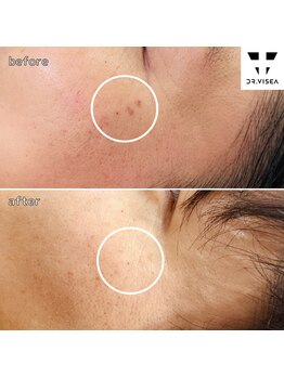 エスポワ/プラズマシミケア