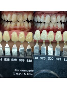 トウキョウスワーズ 池袋店(TOKYO SWRS)/#ホワイトニング #池袋 #渋谷