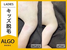 アルゴ 小松店(ALGO)/小学生女の子のビフォーアフター