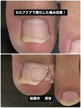 巻き爪じゅん 千葉駅前店/セルフカット痛み悪化の原因に！