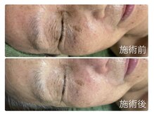 1回の施術で自分史上最高の肌を。