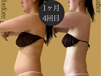 マルレ(MARLE)の写真/【くびれ美人計画★】インディバで頑固なお腹・腰まわりのセル脂肪にアプローチ！ぽっこりお腹もスッキリ♪