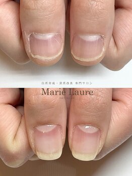 マリーロール 梅田店(Marie Laure)/自爪育成/深爪矯正/ネイルケア