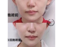 美プラス/《20代》小顔矯正