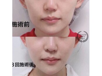 美プラス/《20代》小顔矯正