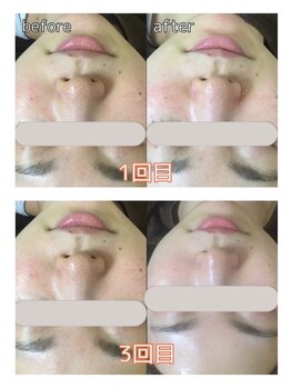 ビューティースタイリング 自由が丘店(beauty styling)/ハイドラフェイシャル