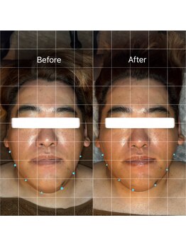 セメ(S’aimer)/脳洗浄で面長改善♪♪