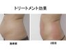 【驚く効果◎脂肪冷却！！】ラジオ波・冷却吸引・ショックプレッシャー2部位