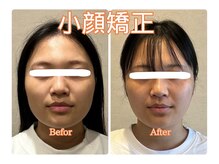 幸治鍼灸整骨院/小顔矯正で小顔になりました