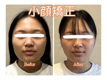 幸治鍼灸整骨院/小顔矯正で小顔になりました