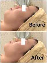 スペチアーレ 夙川/1度で激変！小顔ハイリフ無制限