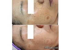 ソイ(Soi)/濃いシミも光の照射でキレイに♪