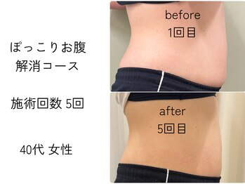 ほねつぎ一休さん 宇品店/ぽっこりお腹解消コース