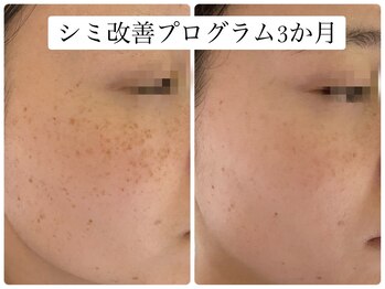 ヌー 栄(nuu)/シミ改善プログラム3か月