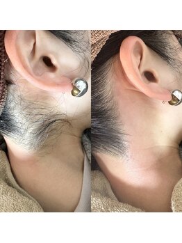 ルピナス(Lupinus)/うなじwax脱毛