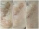 ポードランジェ(Peau de L`ange)の写真/【１番人気！シミケアデトックスコース】通常コースは１回￥12100(税込)で時間も個数も制限なし！