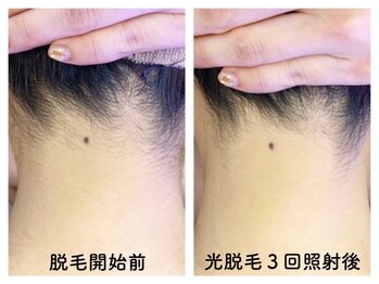 アイラッシュアンドネイル専門店 クラル(CURAR)/うなじ脱毛 ビフォーアフター★