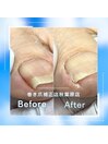 【巻き爪/陥入爪補正】