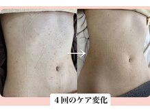 スキンハピネス(skinhappiness)/お腹ハーブピーリング