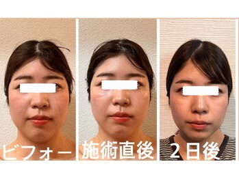 アクアナチュラ(ACQUANATURA)/お顔がシュッと小さくなりました