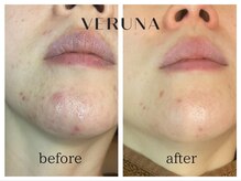 アトワ(A toi)/ハーブピーリング(ハードタイプ)