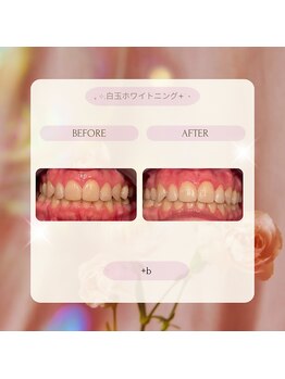 プラスビーセルフ(+b self)/ホワイトニングビフォーアフター
