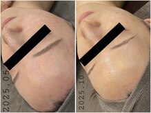 レイズ(RAISE)/当店人気No.1 水光ピーリング