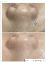 サロン キママ(Salon Kimama)/トーンアップ＆お鼻がピカピカ。