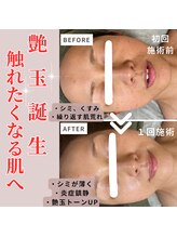 アルエット(Alouette)/ハーブピーリングbefore/after