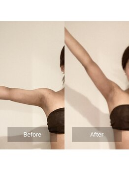 アラマンダ(Allamanda)/二の腕BeforeAfter